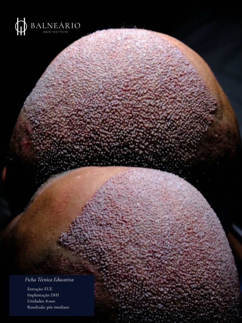 Resultado transplante capilar — Caso 6 — Balneário Hair Institute